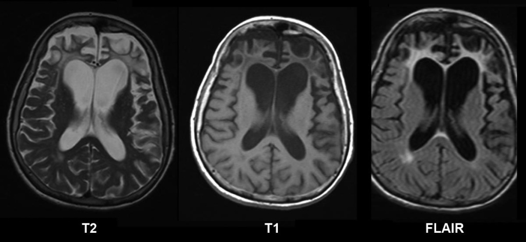 Атрофия коры головного мозга (Болезнь Пика) - симптомы, лечение